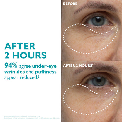 Trelia™ Eye Tape
